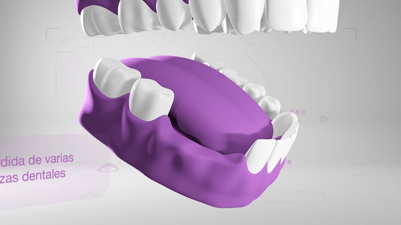 Puente sobre implante · Animación 3D